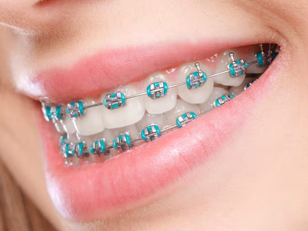 Orthodontics and Braces