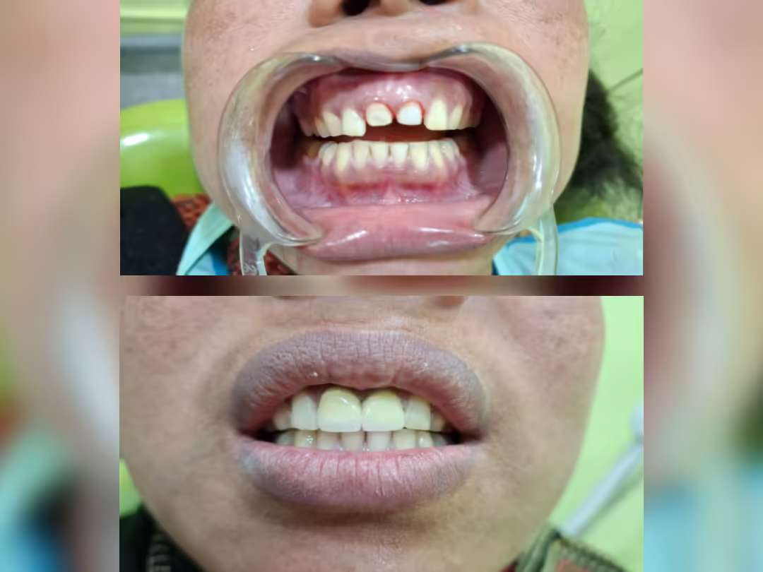 Dental Crown