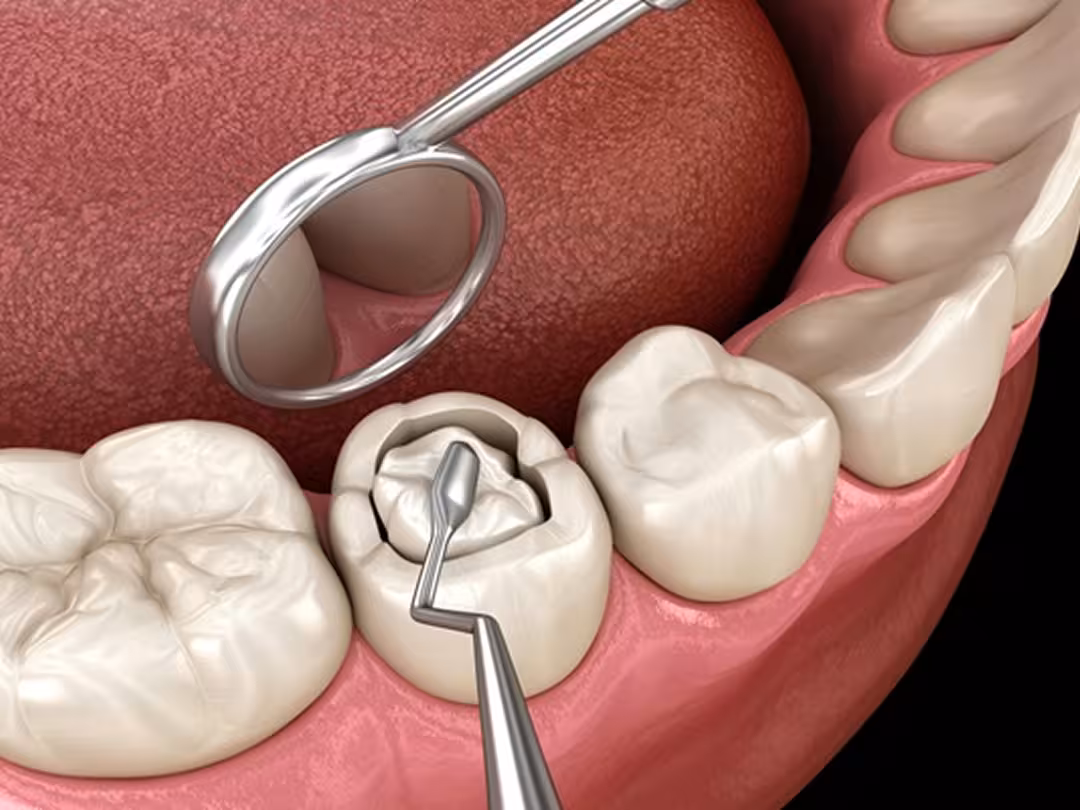 Dental Fillings