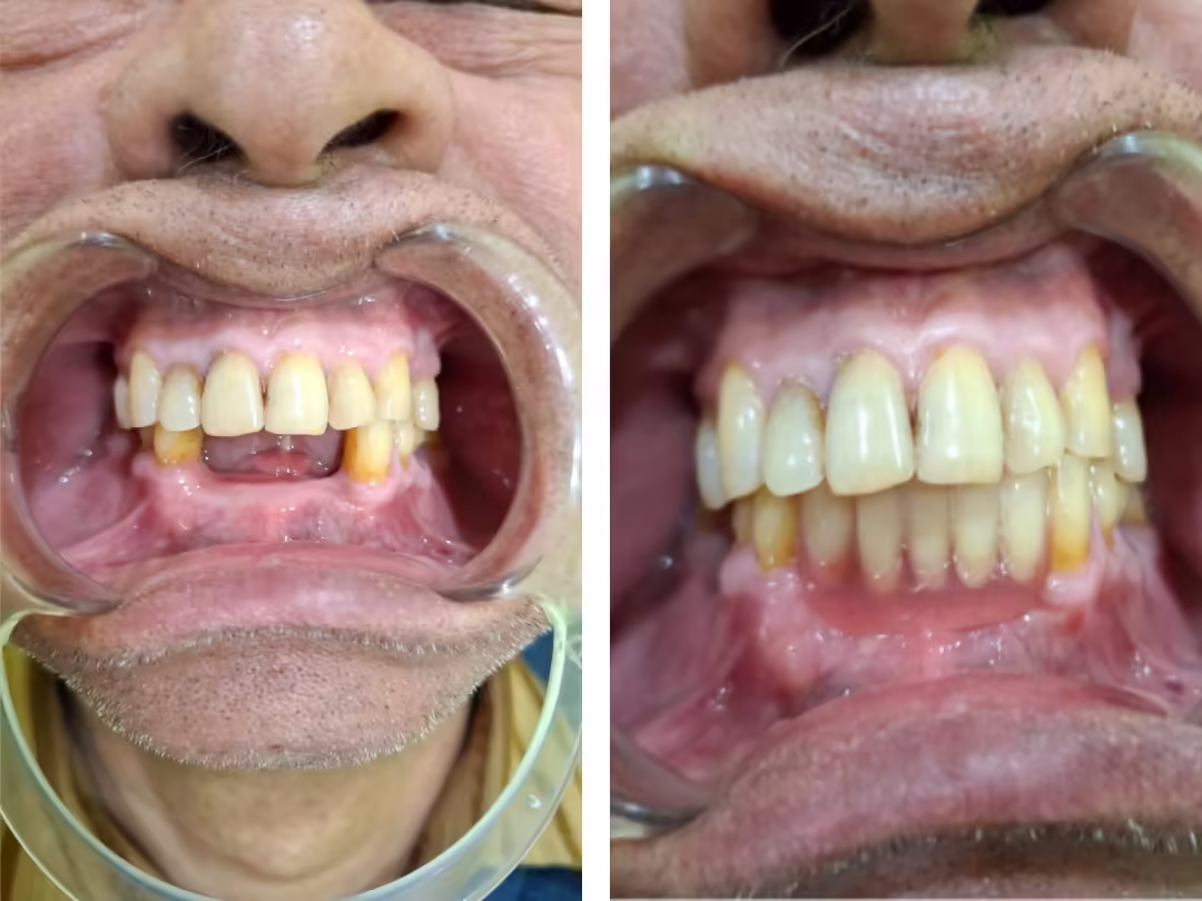 Removable Prosthesis