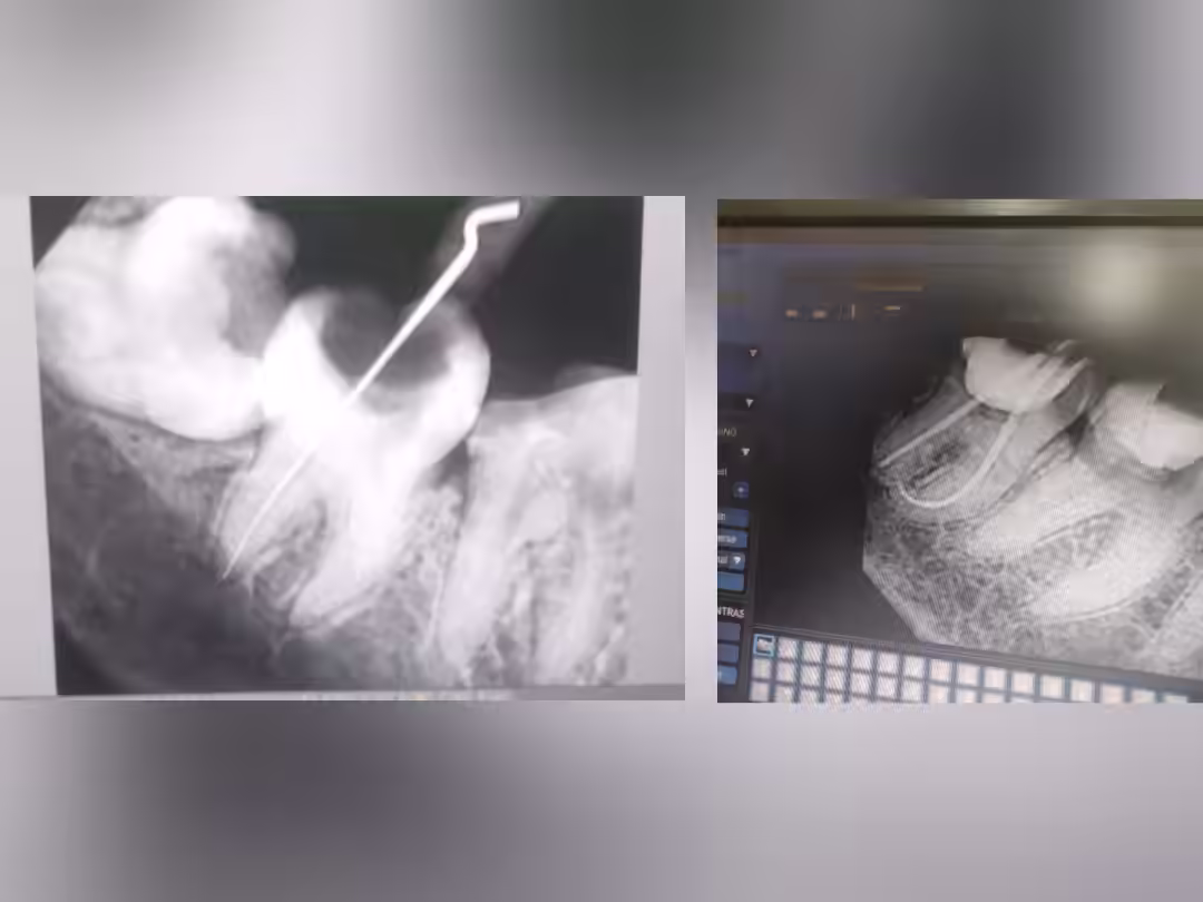Root Canal Treatment