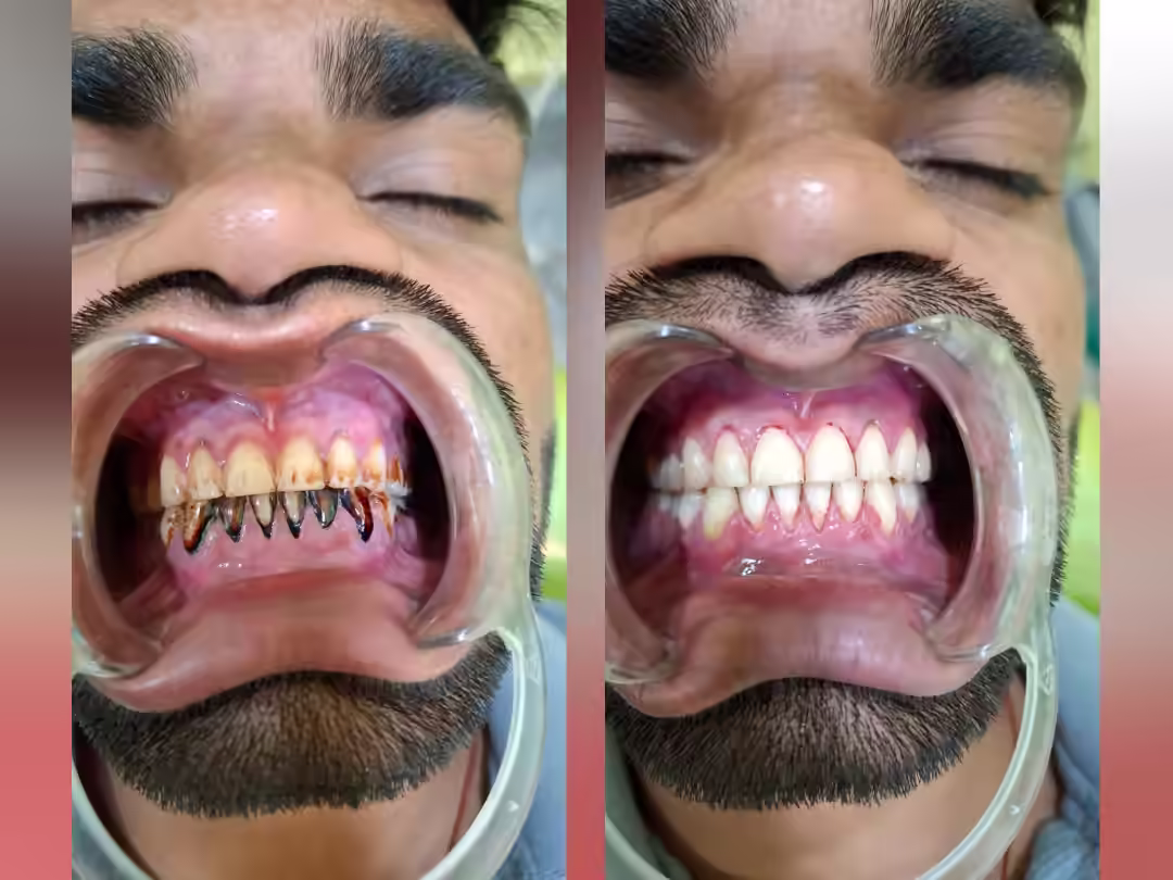 Teeth Cleaning