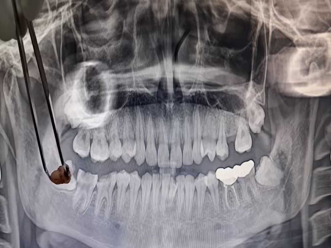 Tooth Extraction
